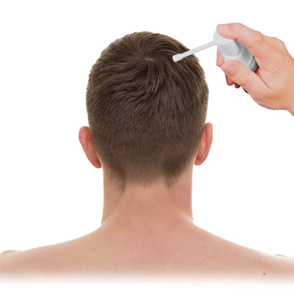 Стимулирование волос. Minoxidil. Иголки от выпадения волос. Applying Minoxidil for hair.