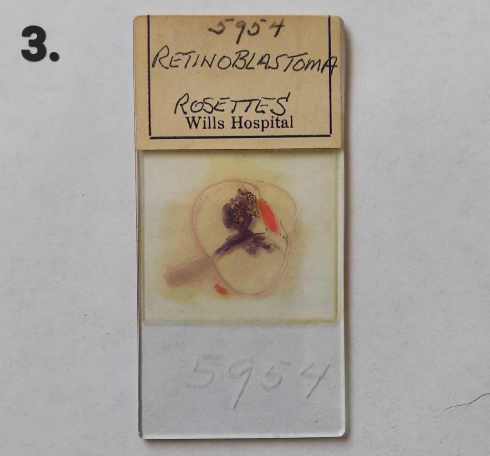 Vintage Medical Slides – Human Eye (Retinoblastimo)