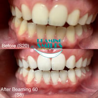Image 3 of Teeth Whitening Treatments (Tax included)