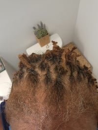 Image 3 of Alopecia  Edge Repair