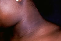 Image 6 of  “CLARITY” ACANTHOSIS NIGRICAN (MALASMA) CREAM  