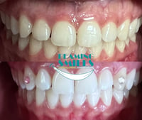 Image 2 of Teeth Whitening + Tooth Gems Specials