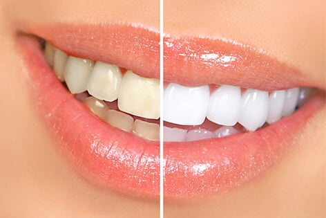 Image of Teeth Whitening Kit