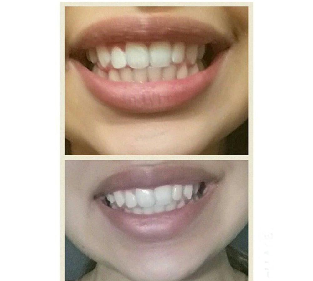 Image of AT HOME TEETH WHITENING SYSTEM