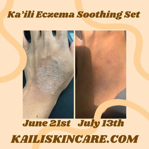 Image of Ka'ili Eczema Soothing Set