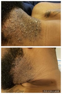 Image 2 of SMOOTH SKIN ELIXIR  Clears ingrown hairs + Razor bumps