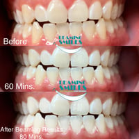 Image 4 of Teeth Whitening Treatments (Tax included)