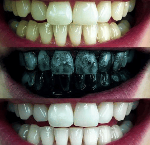 activated charcoal toothpaste results