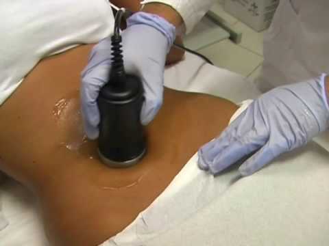 Image of Fat Freeze with Skin Tightening