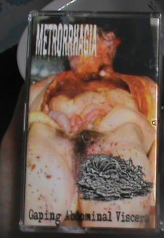 Image of NPP133 Botched Anastomosis J-Pouch, Metrorrhagia – Gaping Abdominal Viscera split tape