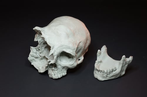 Image of Deformed Human Skull