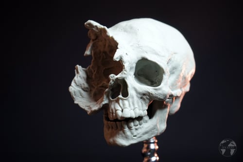 Image of Deformed Human Skull