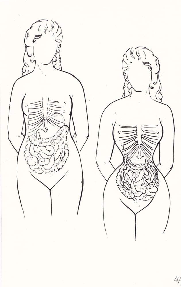 Image of Effects of Victorian Corsetry