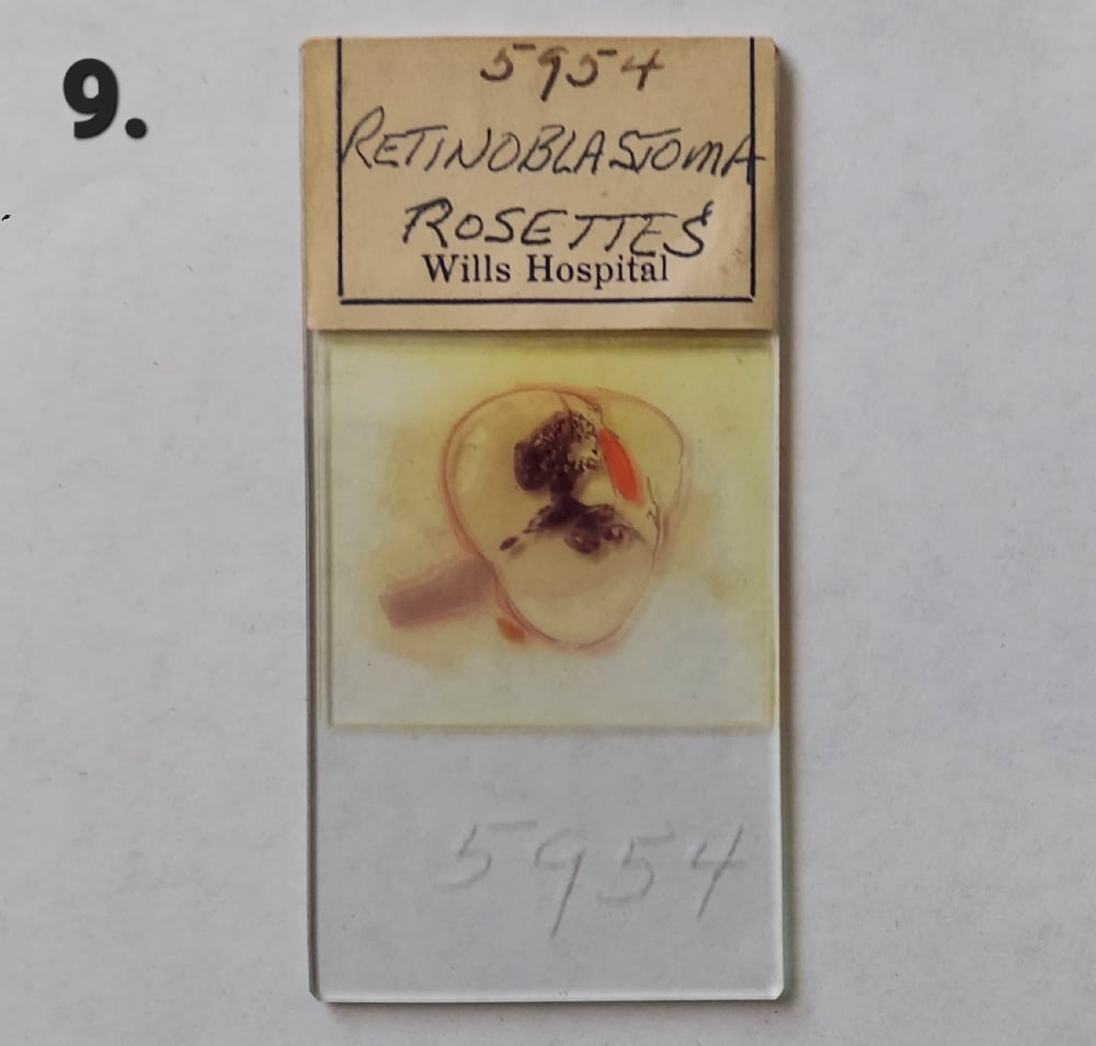 Vintage Medical Slides – Human Eye (Retinoblastimo)
