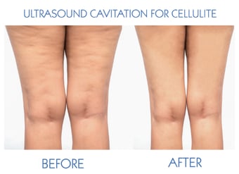 Image of Ultrasound Cavitation & Radiofrequency