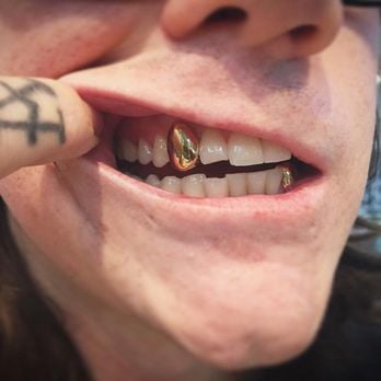 Image of SINGLE GOLD TEETH