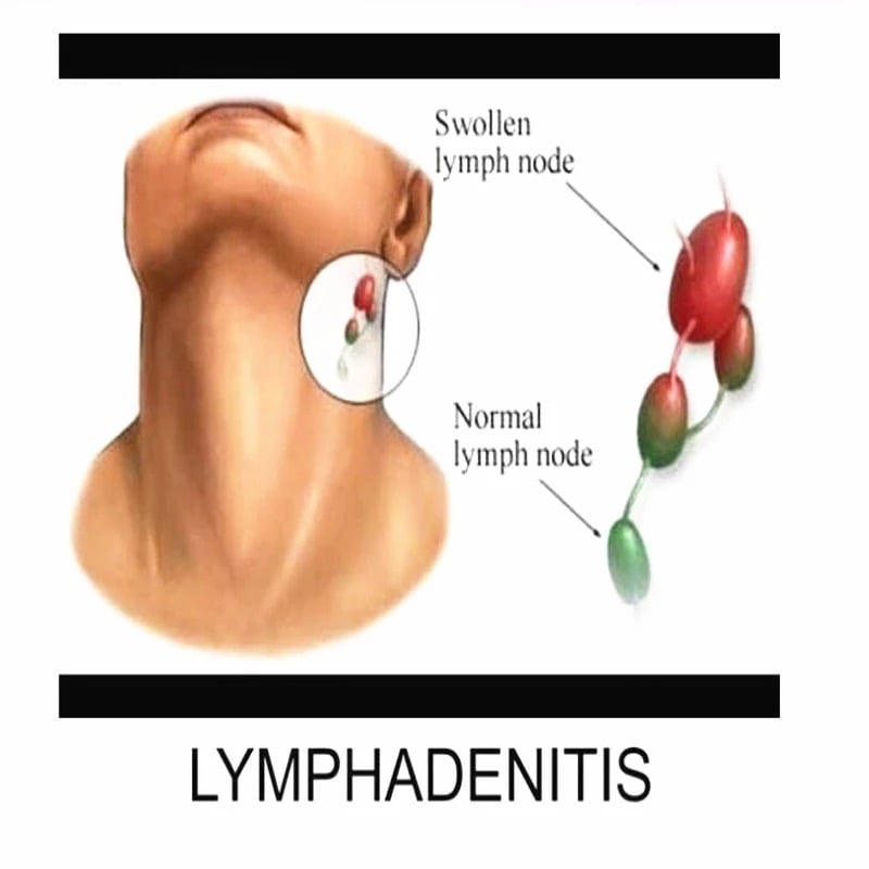 Lymph Nodes Drainage Herb Pads / Yoni Pearls