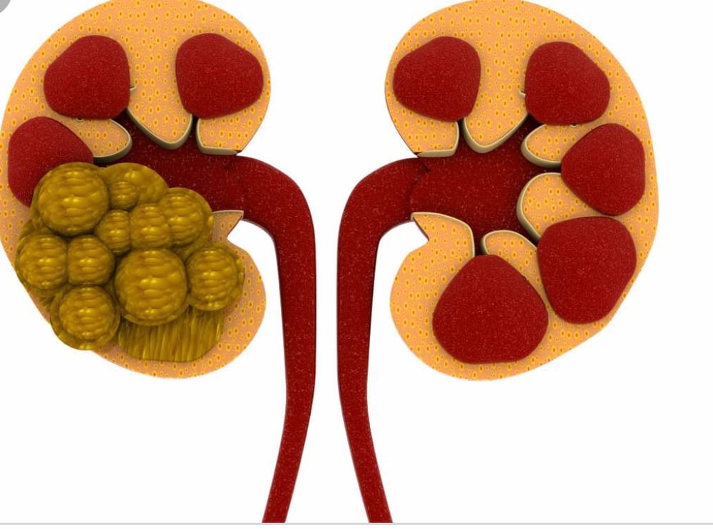 Image of Liver/ Kidney Stones Cleanse Recipe