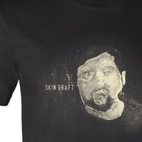 99 Skin Graft