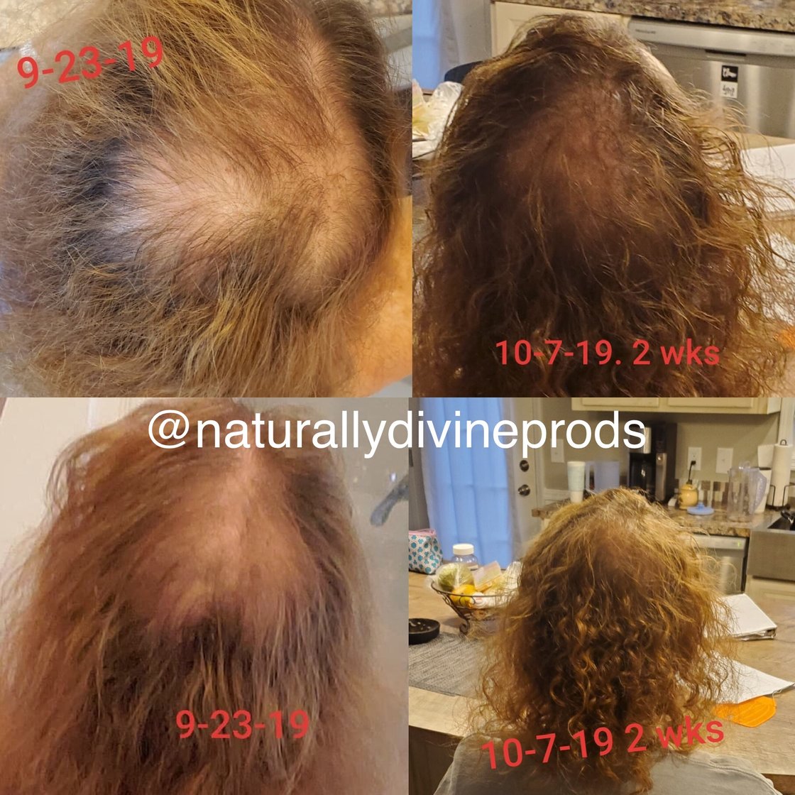 Image of Category: Extreme Hair Regrowth Elixir Systems