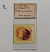 Vintage Medical Slides – Human Eye (Retinoblastimo)