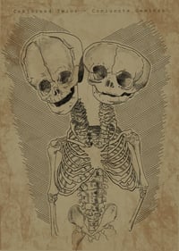 Conjoined Twins 