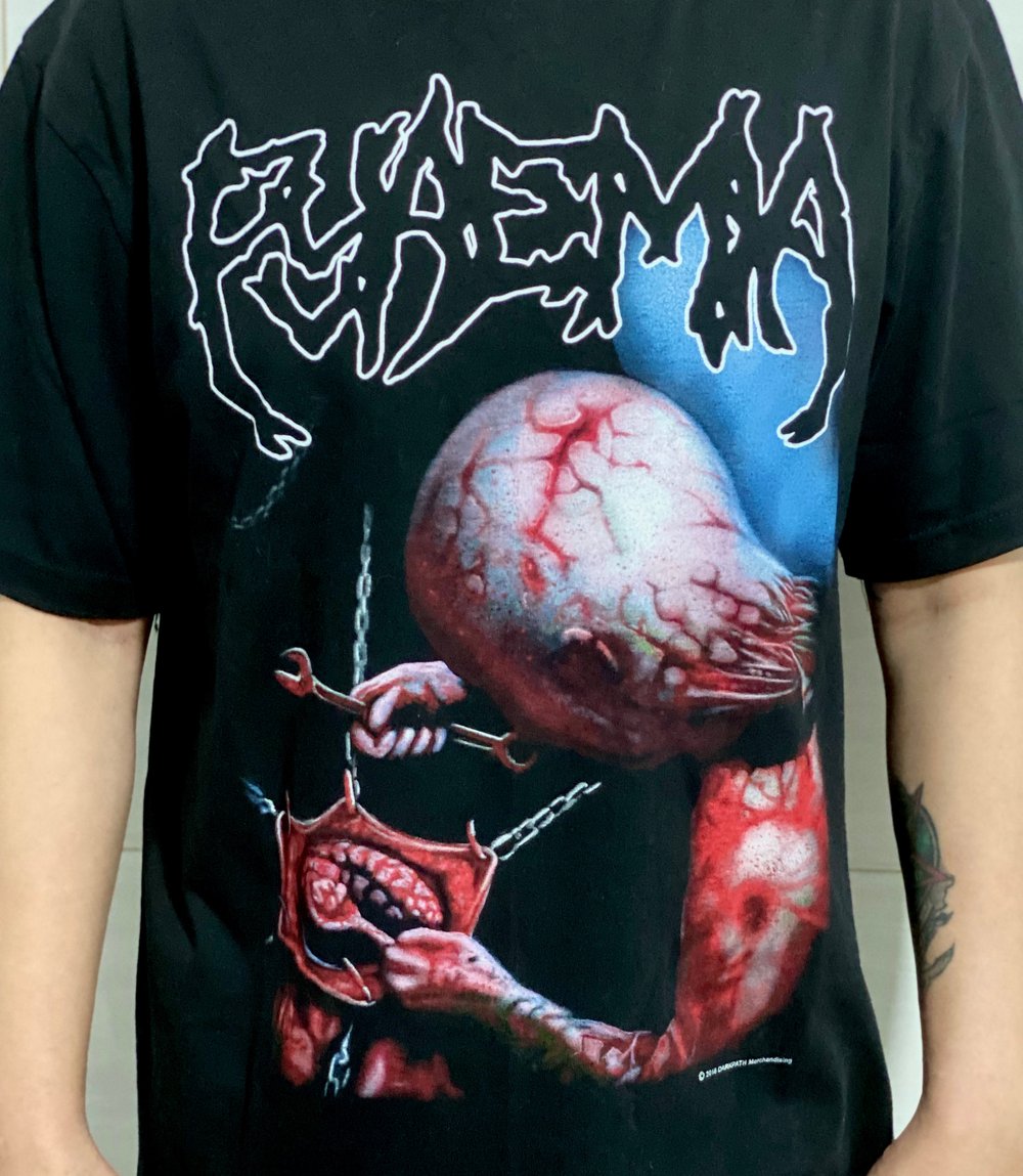 Pathology / Putrid Pile / Cerebral Incubation / Pyaemia 