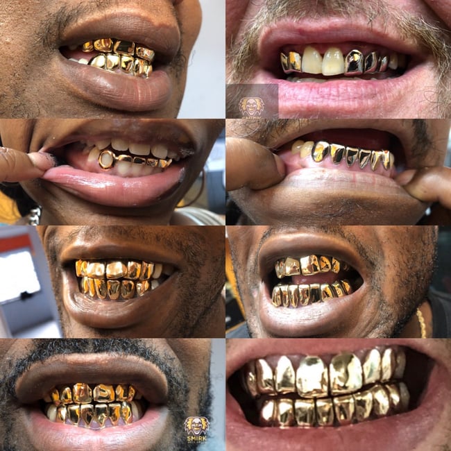 10k vs 14k Gold Grillz: What Is Difference Between Both the Karats?