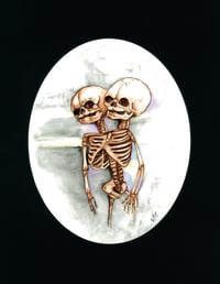 Conjoined Twin Skeleton