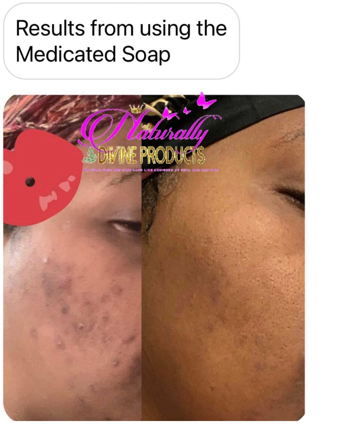 Image of Medicated soap