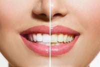 Teeth Whitening 