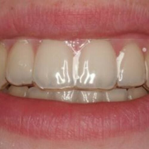 Temporary Replacement tooth in Crystal Clear Retainer