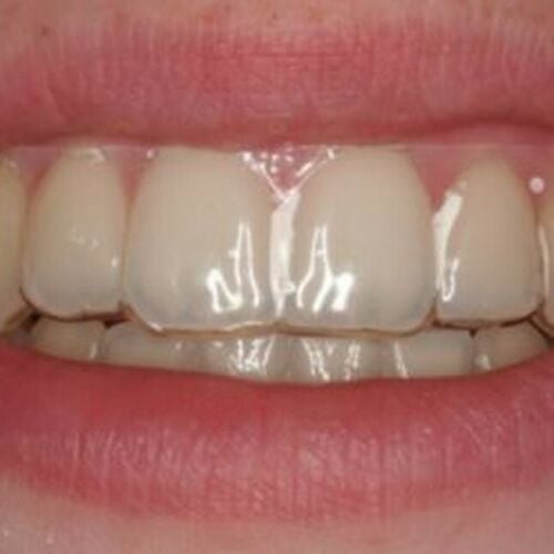 Temporary Replacement tooth in Crystal Clear Retainer | QualityDentalLab