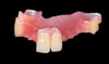 Upper Acrylic Partial Denture