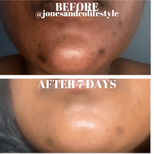 Image of Pore and Hyperpigmentation Set