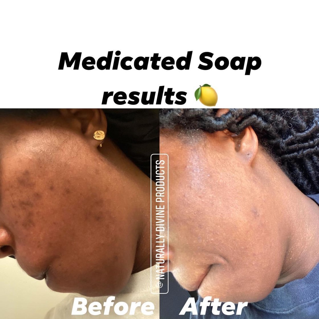 Image of Medicated soap