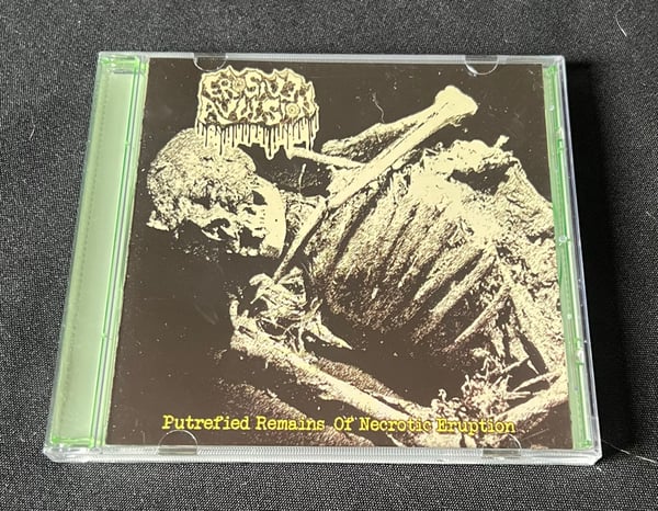 Image of Erosive Avulsion- Putrefied Remains of Necrotic Eruption 