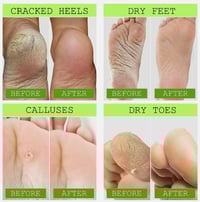 Image 1 of FOOT PEEL TREATMENT