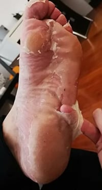 Image 3 of FOOT PEEL TREATMENT