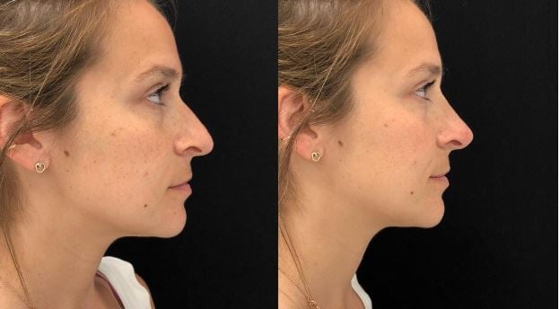 Rhinoplasty Before and After - Dr. Andrew Jacono