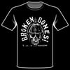 BROKEN BONES
