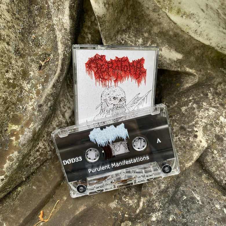 Image of Teratoma " Purulent Manifestations" Tape _  Desiccated Productions