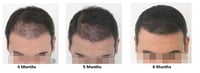 How to Take Care of Your Hair After a Hair Transplant