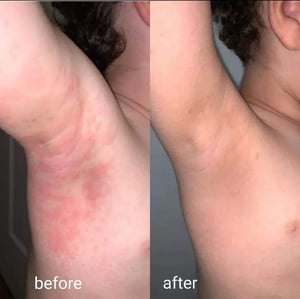 Image of 🌿Herbal Medicated Skin Cream - formulated for eczema