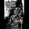 Meatal Ulcer "Intermittent Claudication" 7"