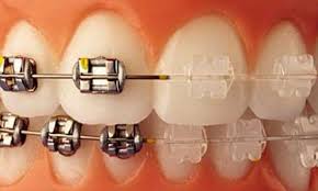 Image of Brackets Esteticos y Roth