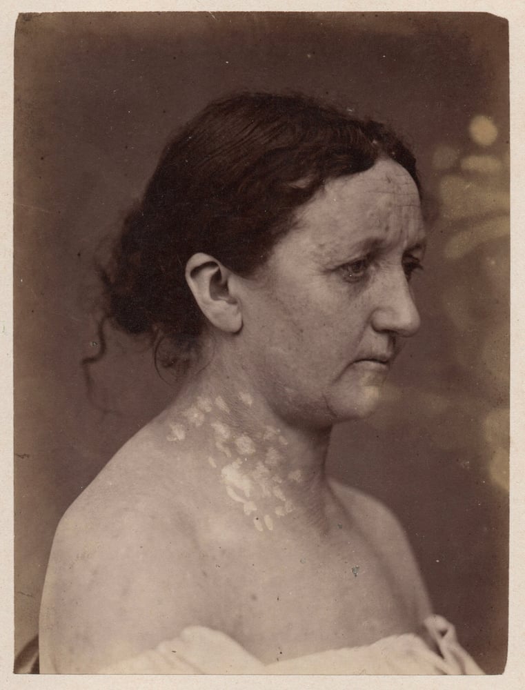 Image of A. de Montmeja: portrait of woman with Syphilide, ca. 1870
