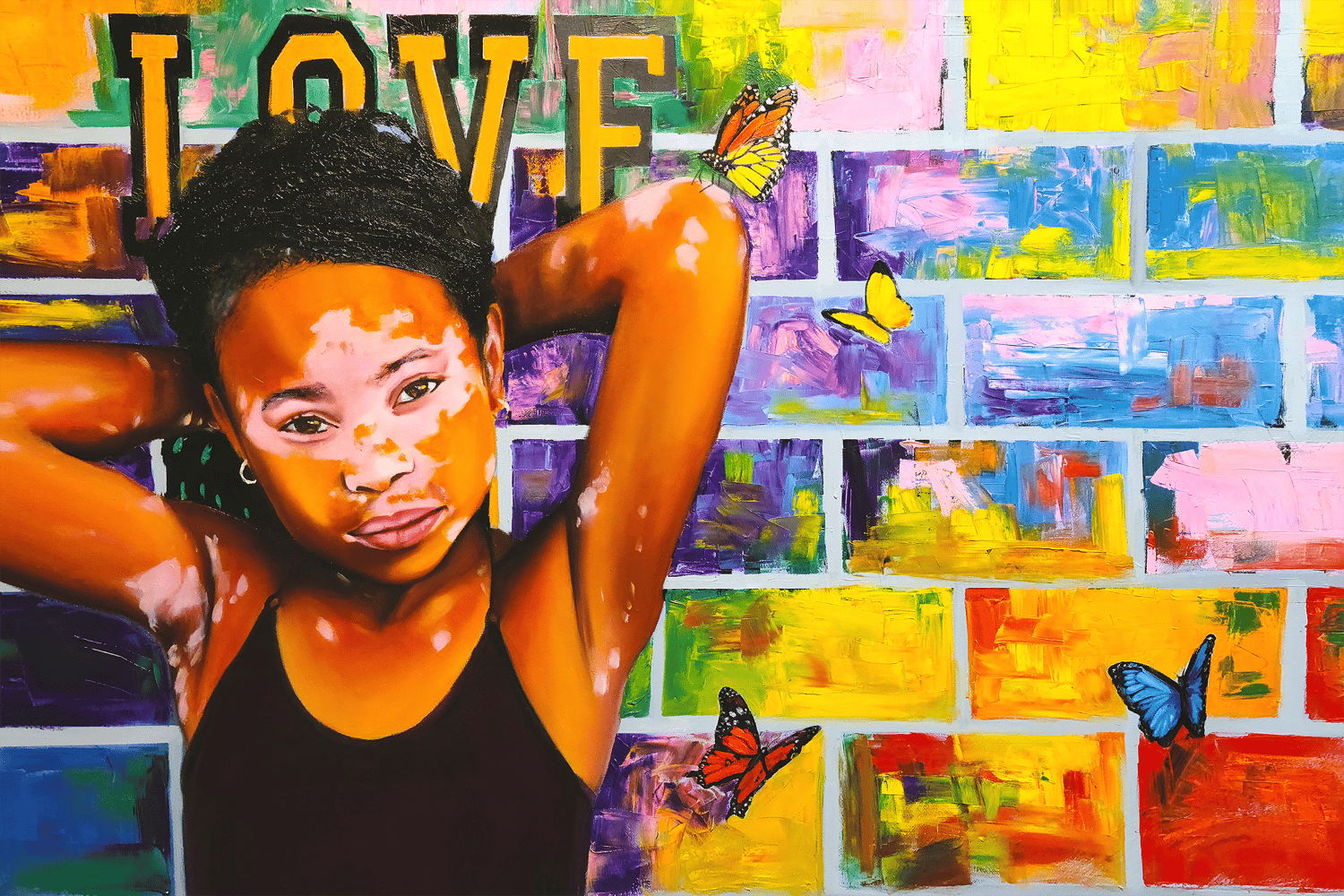 Vitiligo Beauty jahnart