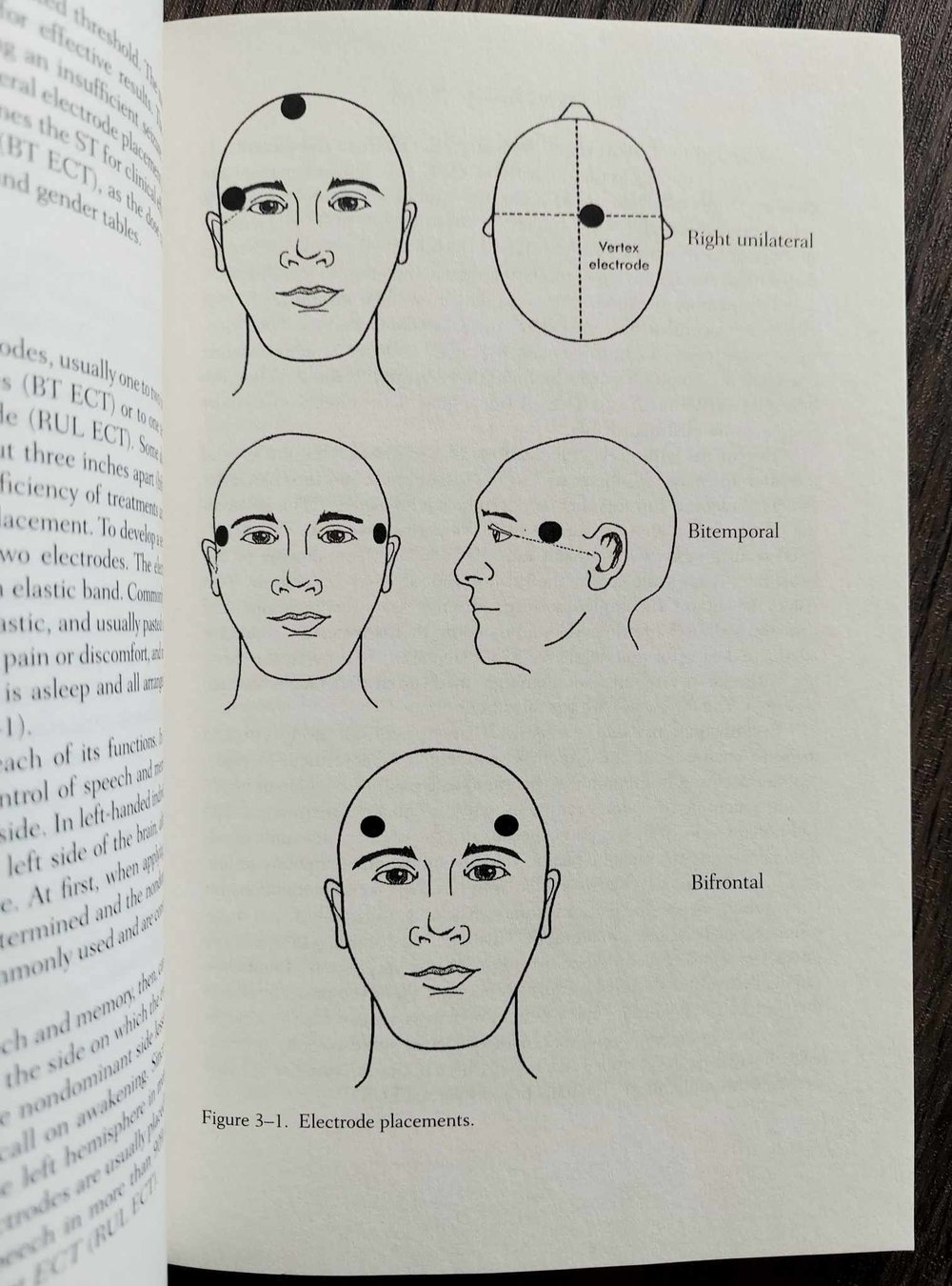 Electroconvulsive Therapy: A Guide for Professionals and Their Patients, by Max Fink