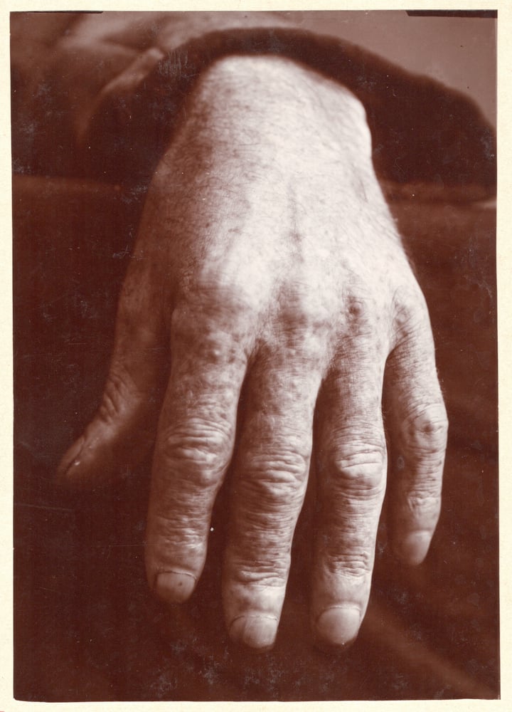 Image of Anonyme: hand with dermatitis, France ca. 1908